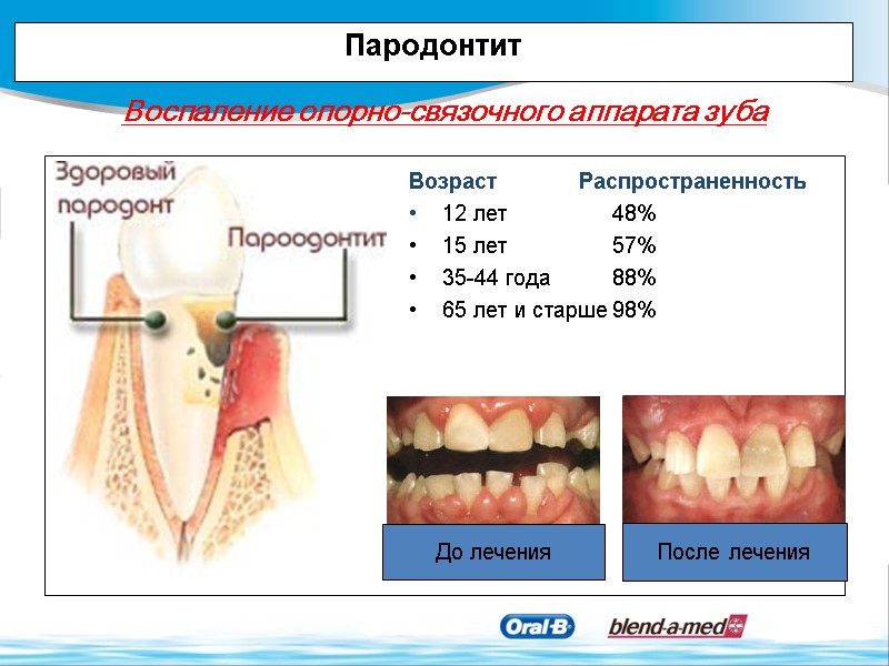 До лечения После лечения Возраст 12 лет 15 лет 35-44 года 65 лет и